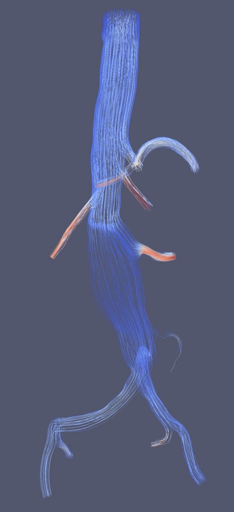 Aortic Repairs